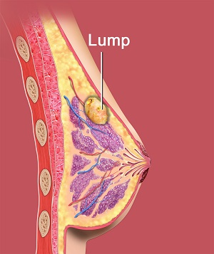 Benign Breast Lumps