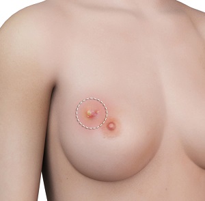 Breast Abscesses