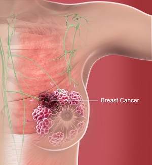 Breast Cancer