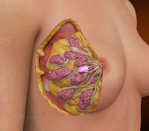 Breast Cyst