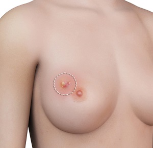 Breast Lump