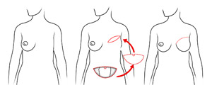 Breast Reconstruction