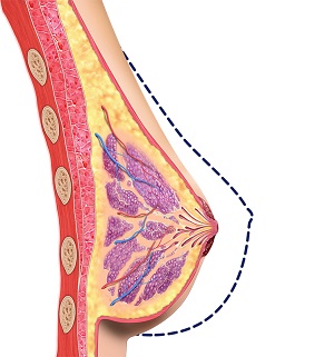 Female breast reduction in Ireland