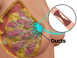 Duct Ectasia