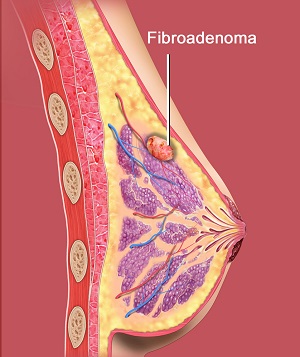 Breast Fibroadenoma: Symptoms, Treatment & Removal