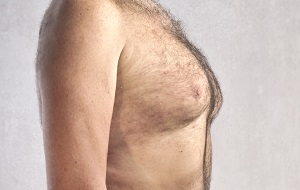 Gynaecomastia A