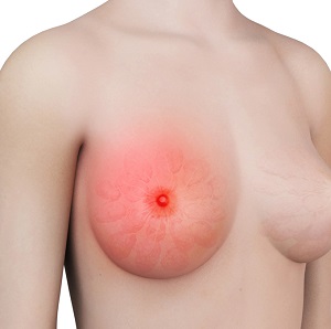 Inflammatory Breast Cancer