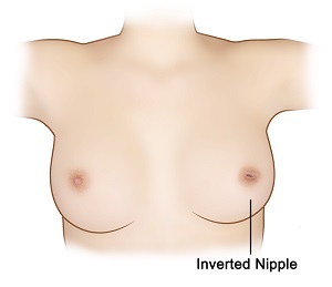 Inverted Nipples