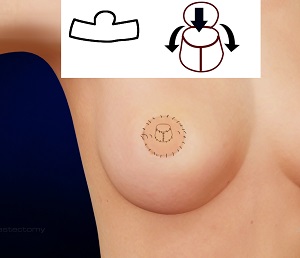 Nipple Reconstruction