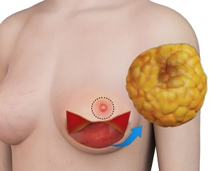 Nipple Sparing Mastectomy