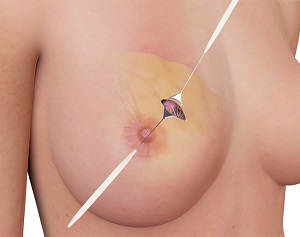 Oncoplastic Breast Surgery