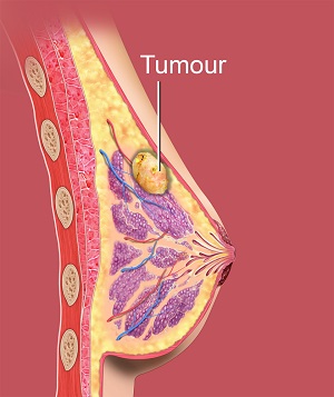 phyllodes tumor growth rate