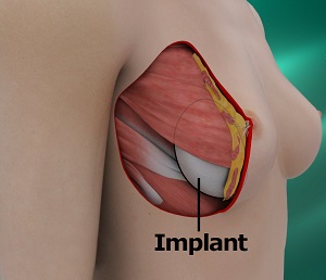 Revision Breast Surgery