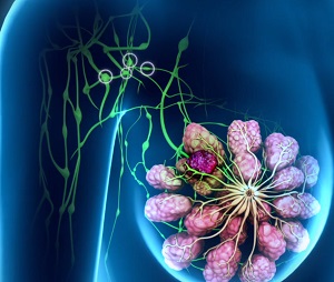 Sentinel Node Biopsy