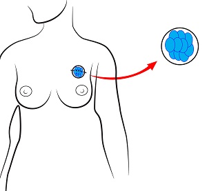 Surgical Treatment of Benign Breast Diseases