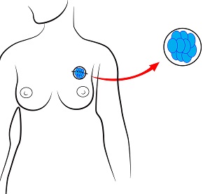 Benign Breast Diseases Treatment Dublin, IE