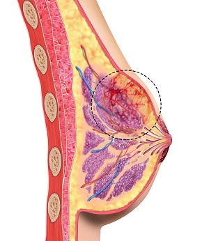 Triple Negative Breast Cancer